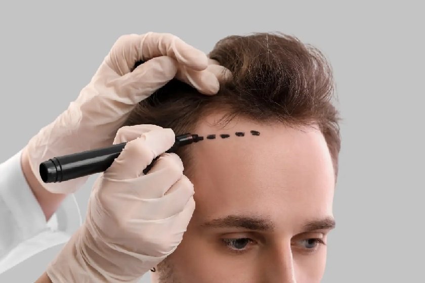 Understanding the Different Hair Transplant Techniques In Sydney